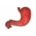 Ulcer gastric